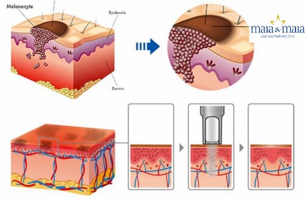 Laser Toning tác động vào các tầng cấu trúc của da Laser Toning tác động vào các tầng cấu trúc của da