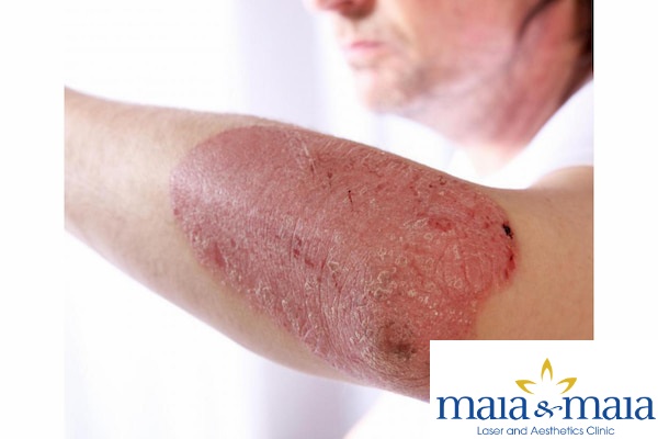 Bệnh vảy nến - Phòng khám chuyên khoa Da liễu Maia Bệnh vảy nến