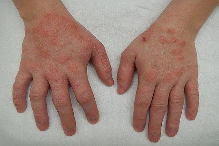 Hình ảnh: Viêm da cơ địa ở trẻ em